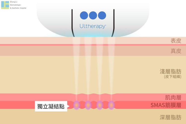 超音波拉提超音波拉皮超聲刀極線音波拉皮極線音波拉提筋膜拉皮下顎線費用價位推薦效果美國機音波拉皮因波拉提術後保養腫推薦醫師林上立上立皮膚科診所多少錢幾條液態拉皮(2).jpg