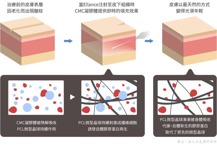 埋線立提少女線費用埋線拉提失敗臉部埋線價格臉部埋線效果埋線拉提副作用埋線立提少女線推薦立提少女線術後4D埋線拉皮埋線 (3).jpg