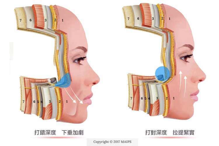 舒顏萃sculptra3D聚左旋乳酸塑然雅童顏針淚溝液態拉皮作用舒顏萃價格費用副作用效果按摩二代童顏針價位價錢淚溝按摩法令紋PLLA (2).jpg