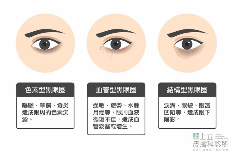 dark circles around hisher eyes-tear trough-ellanse (7).jpg