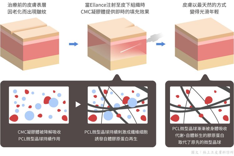 洢蓮絲、艾麗斯引發選擇困難？其實，你不一定要二選一