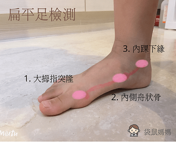 1. 大拇指突隆 (1)
