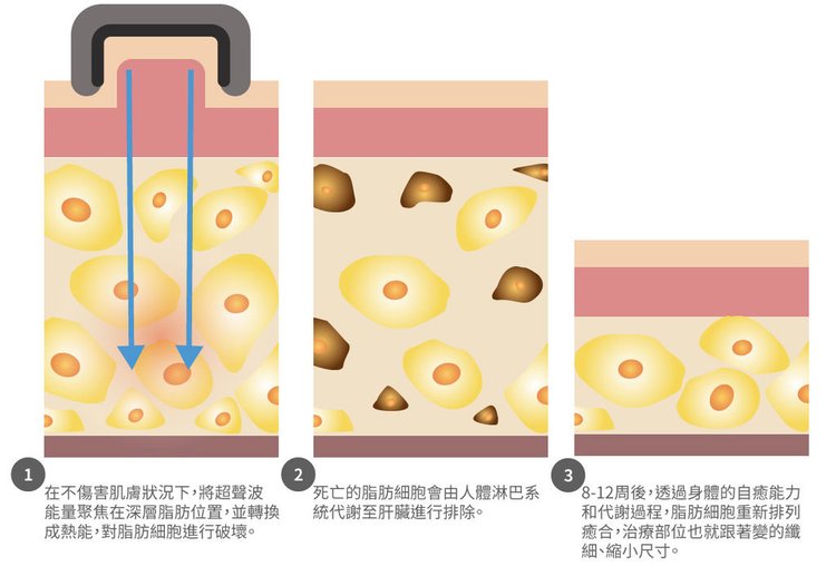 立塑推薦liposonix立塑無創溶脂價格立塑效果瘦身減肥體雕瘦肚子瘦大腿健身瘦身快速減脂快速瘦肚子高雄立塑高雄減脂推薦高雄彤曜時尚診所沈育如醫師2.jpg