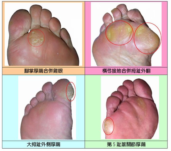 鞋底磨損-4圖