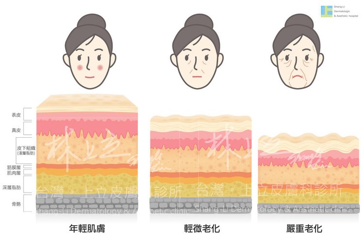 舒顏萃sculptra3D聚左旋乳酸塑然雅童顏針淚溝液態拉皮作用價格副作用效果淚溝按摩法令紋PLLA林上立上立皮膚科診所推薦醫師一瓶幾CC舒顏萃玻尿酸台北推薦 (6).jpg