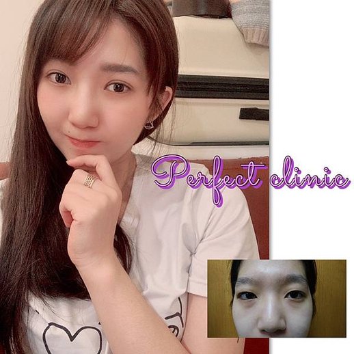 萌萌噠的雙眼讓世界都亮了起來 #雙眼皮
