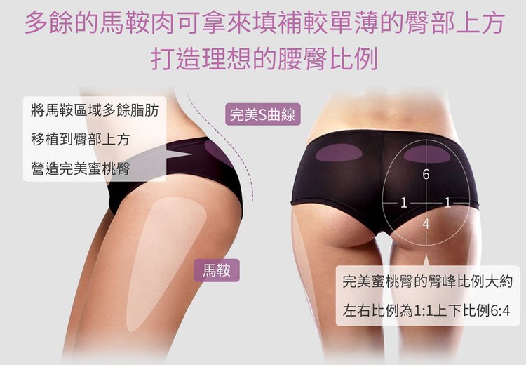 腹部環抽馬甲線渦漩抽脂抽脂手術風險抽脂價格05.jpg