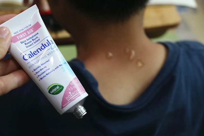 鼻子過敏、皮膚敏感、瘀青、蚊蟲叮咬 |你一定要知道的家庭必備