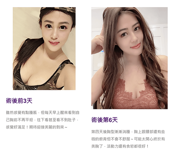 台北隆乳女醫師 晶華美醫診所 複合式隆乳 魔滴隆乳 內視鏡果凍矽膠隆乳