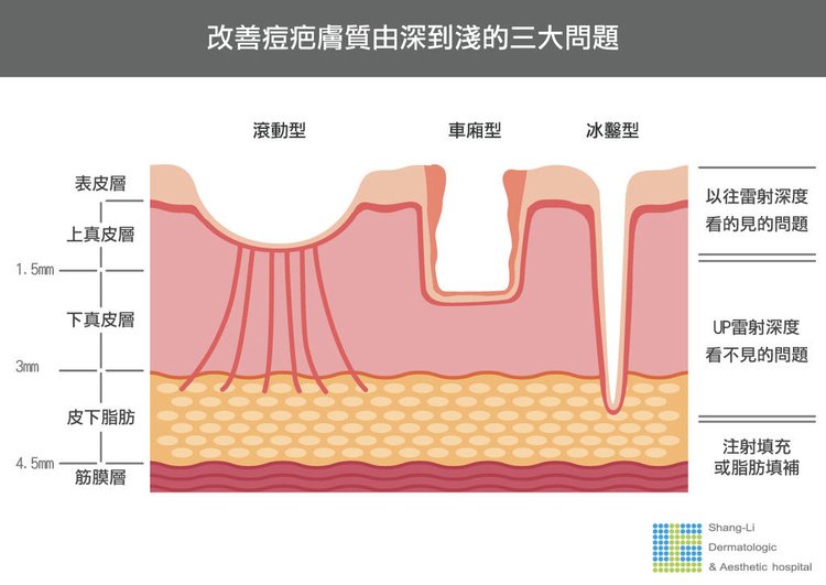 Up雷射ultrapulse汽化雷射雷射效果痘疤凹疤光老化痘疤治療副作用費用價錢痘疤保養效果凸疤深層痘疤up雷射永和皮膚科up雷射恢復期 (5).jpg