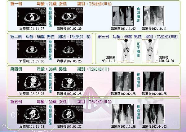 103食道癌同步並用化學放射療法_cr11