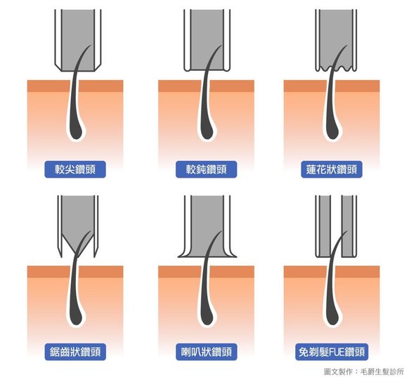 現代FUE鑽頭種類繁多，取髮的效果和試用情況也不一樣，而FUE完全免剃髮的鑽頭尤其特殊(右下角)，側管有開口的特殊鑽頭才能取髮。