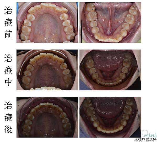 白梓吟(上下顎照）