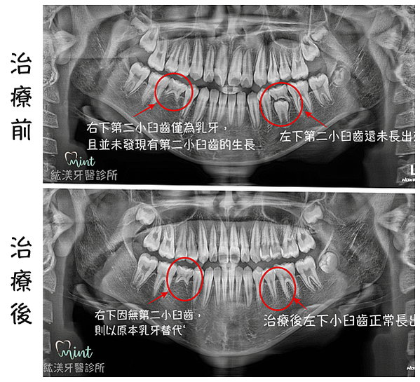 Paoo術前術後照