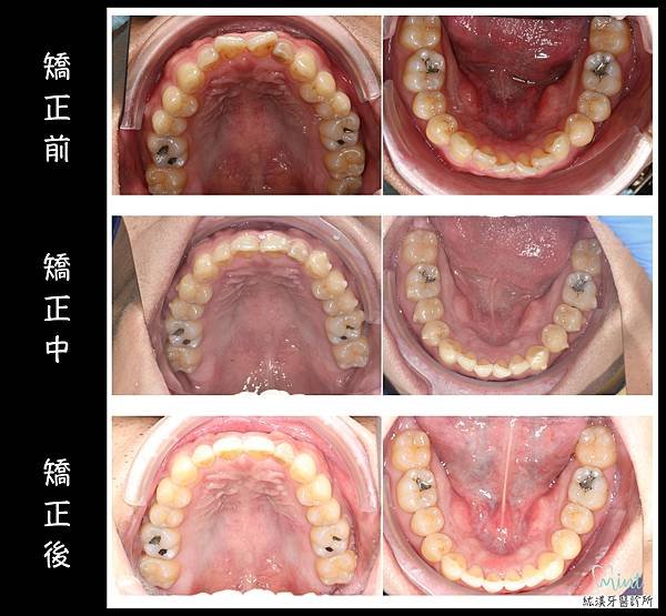 蔡思暐-上下顎-1