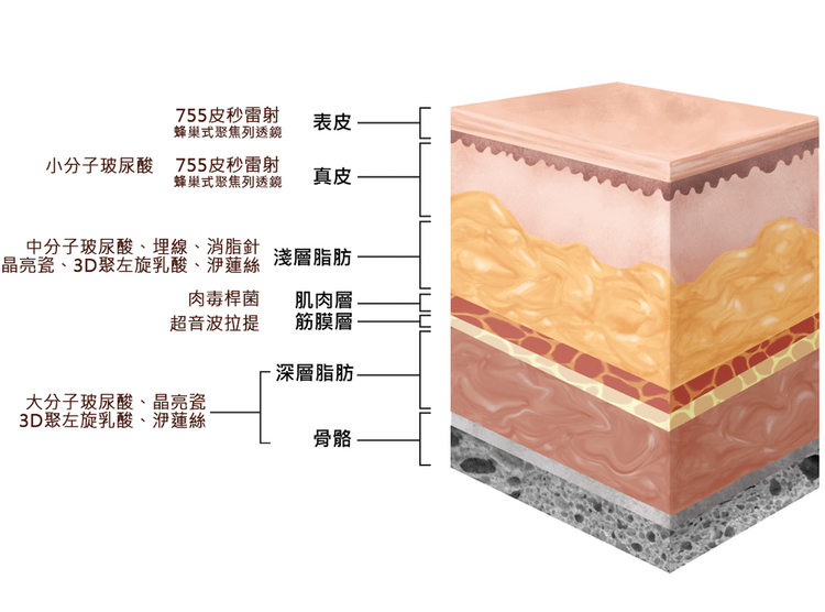 液態拉皮上立提舒顏萃sculptra3D聚左旋乳酸塑然雅童顏針淚溝洢蓮絲ellanse聚己內酯PCL依戀詩易麗適少女針奇蹟針法令紋8.png