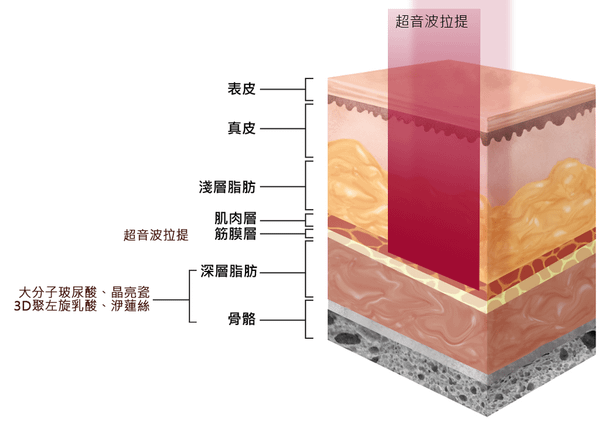 液態拉皮上立提舒顏萃sculptra3D聚左旋乳酸塑然雅童顏針淚溝洢蓮絲ellanse聚己酯PCL依戀詩易麗適少女針奇蹟針06.png