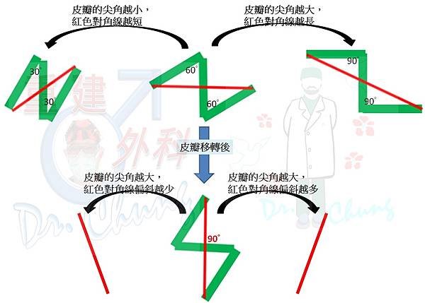 包皮繫帶的重建方式—下篇(The reconstructiv