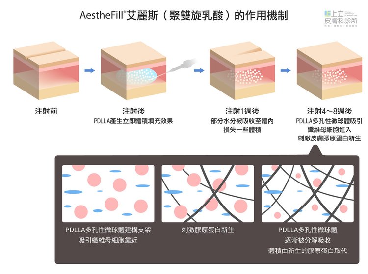 洢蓮絲、艾麗斯引發選擇困難？其實，你不一定要二選一