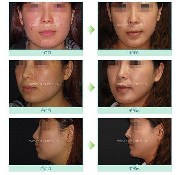 謝明吉 削骨手術 V-line 雕塑術
