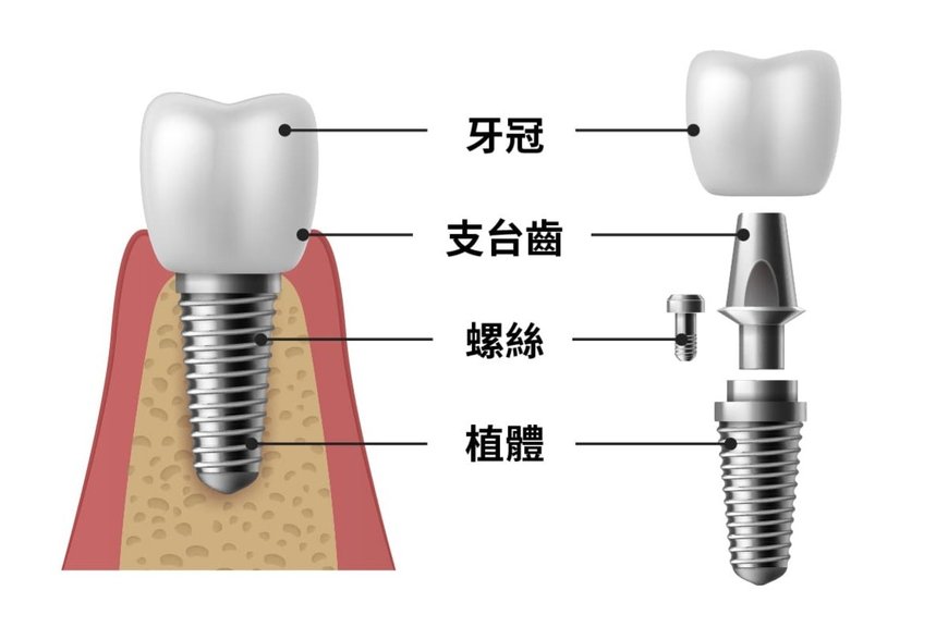 3月9日 首度接受植牙手術