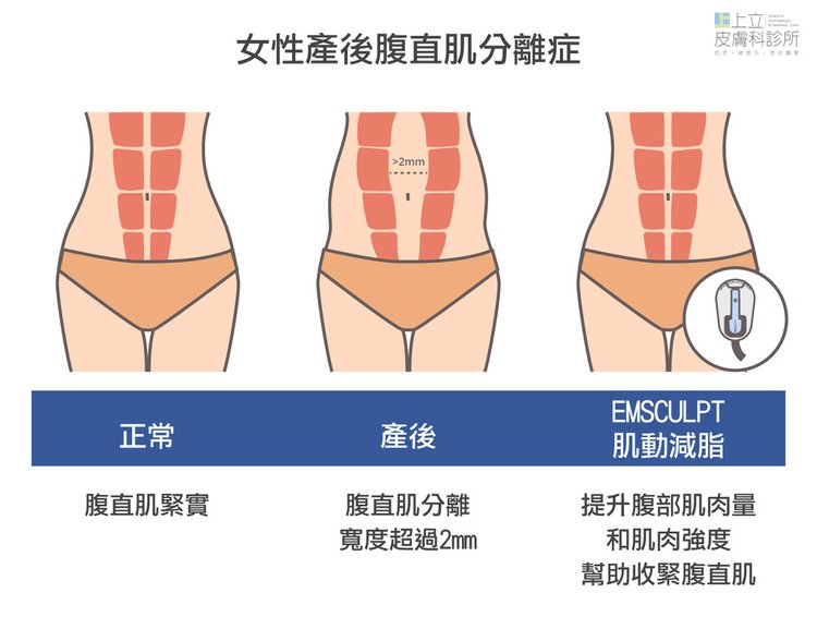 12-Postpartum-Rectus Abdominis Separation-Muscle.jpg