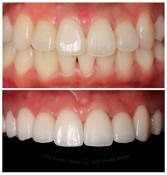 Z-Veneer#14-#24 (1799) G