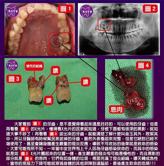 太可怕了！這些牙不拔，會讓身體變成墳場！