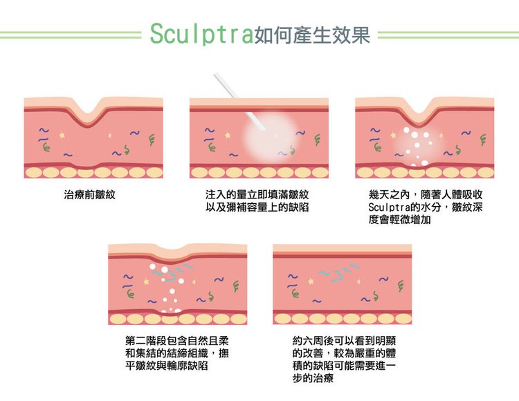 童顏針聚左旋乳酸sculptra3D聚左旋乳酸塑然雅全臉拉提抗老回春舒顏萃費用舒顏萃效果舒顏萃是什麼高雄舒顏萃推薦高雄皮膚科診所彤曜時尚診所沈育如醫師2.jpg