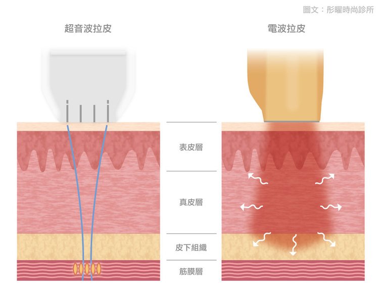 音波拉皮費用音波拉皮推薦音波拉皮多久有效果音波拉皮術後保養音波拉皮會痛嗎 (7).jpg