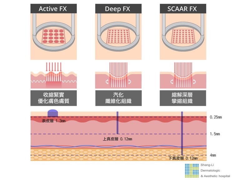 Up雷射ultrapulse汽化雷射雷射效果痘疤凹疤光老化治療副作用費用價錢up雷射永和皮膚科up雷射恢復期痘疤ppt林上立醫師上立皮膚科05.jpg