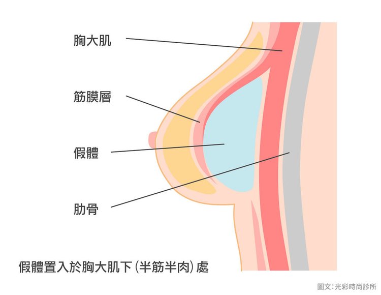 ​​​​​​​內視鏡隆乳隆乳手術風險水滴形絨毛矽膠隆乳乳房發育隆乳價格豐胸手 術內視鏡光彩時尚診所台北醫美推薦果凍隆乳水滴隆乳