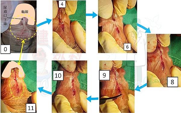 包皮環切前後的繫帶變化--個案探討(上) (The case