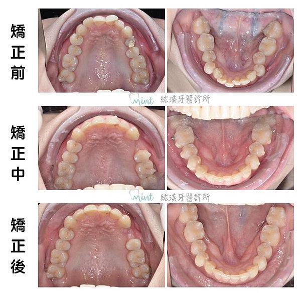 上下顎照