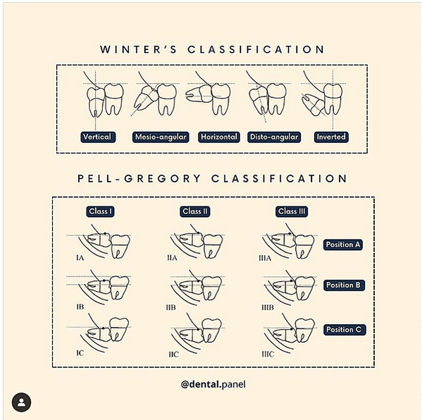 @齒顎矯正每日一說~~0216阻生智齒的分類(classif