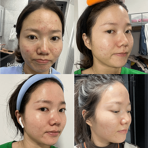 婚前大爆痘必看~最在意的痘痘、痘疤、暗沉、細紋，新娘安瓶推薦