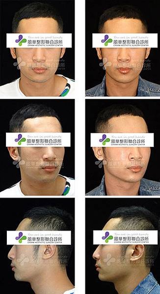謝明吉 正顎手術 削骨手術 臉型植入