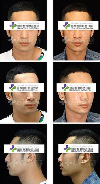 謝明吉 正顎手術 削骨手術 臉型植入