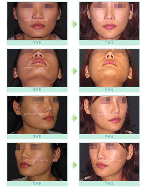 謝明吉 削骨手術 V-line 雕塑術