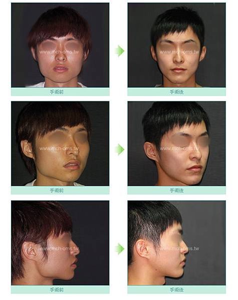謝明吉醫師 削骨手術