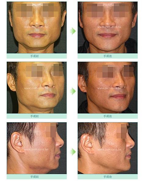 謝明吉醫師 削骨手術