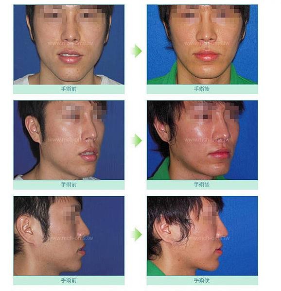 謝明吉 謝明吉醫師 臉部拉皮 加強骨骼支撐合併拉皮手術