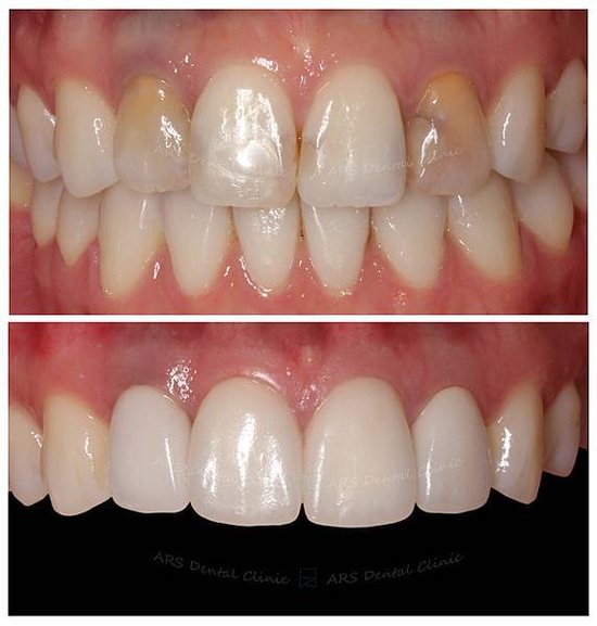 Q-Veneer+全瓷冠#12-#22 (3111) G