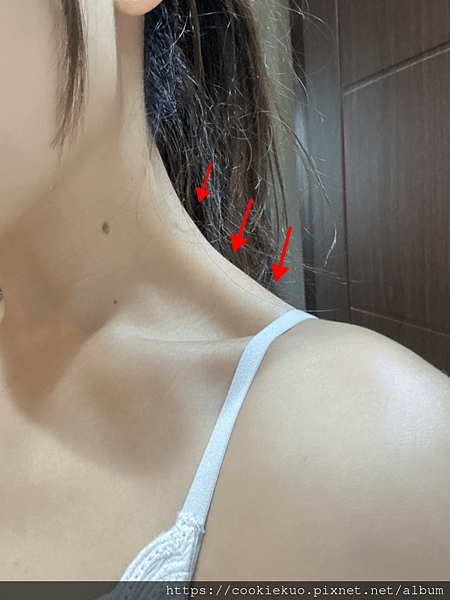 台北＜琢月診所＞肉毒瘦肩針，徹底擺脫媽媽肩，讓我回歸小姐姿態