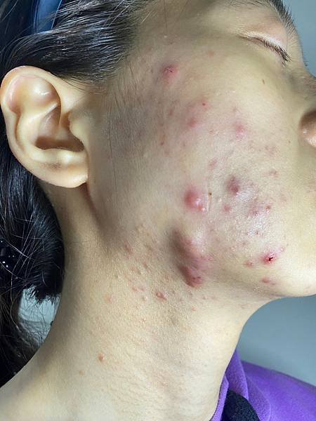 &lt;健康-子宮內膜異位/抗痘&gt;子宮肌腺症甘苦談-不自信的開始往