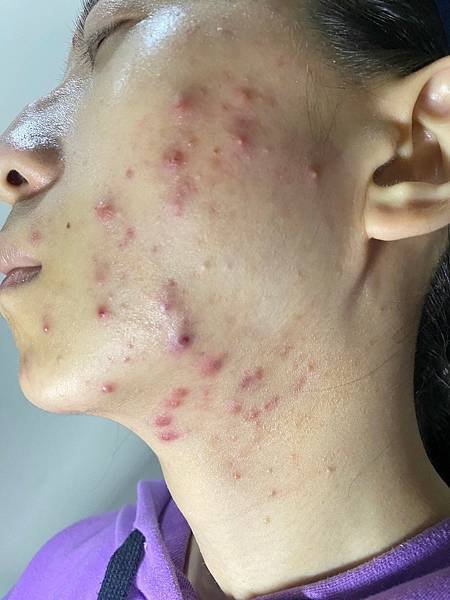 &lt;健康-子宮內膜異位/抗痘&gt;子宮肌腺症甘苦談-不自信的開始往