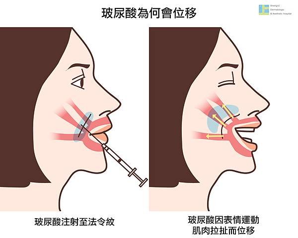 洢蓮絲ellanse聚己內酯PCL依戀詩易麗適少女針奇蹟針液態拉皮上立提二代童顏針膠原蛋白增生推薦醫師液態拉皮二代童顏針台北推薦診所上立皮膚科林上立醫師 (3).jpg