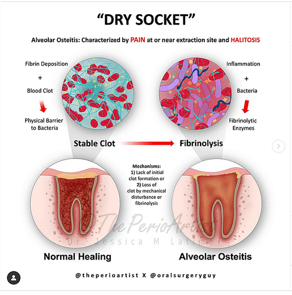 @齒顎矯正每日一說~~0223dry socket(乾性齒槽