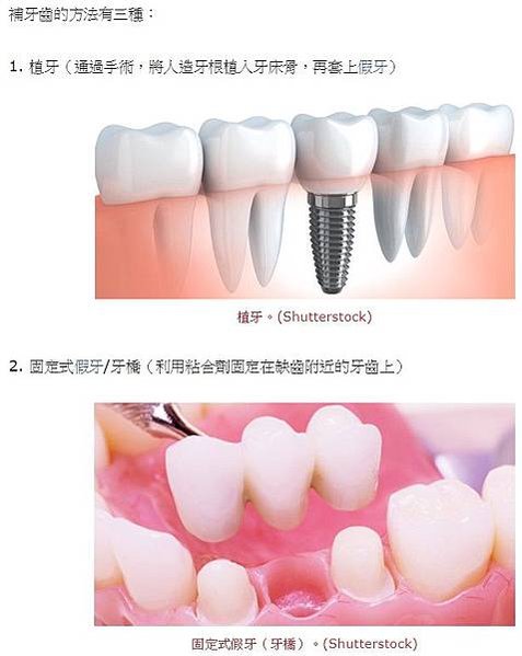 植牙費用/隱形牙套/2成6老年人全口無牙/免費假牙/老人全口