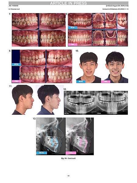 2024隱形牙套矯正論文於Seminars in Ortho